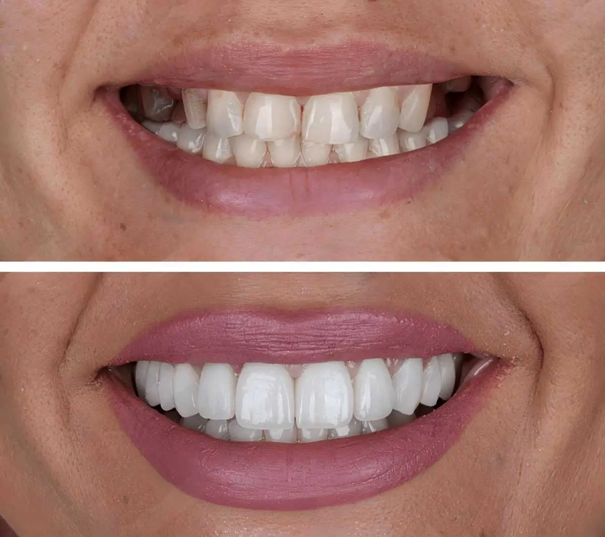 Tandimplantat malmo hos Ali Tamali tandläkare Malmö